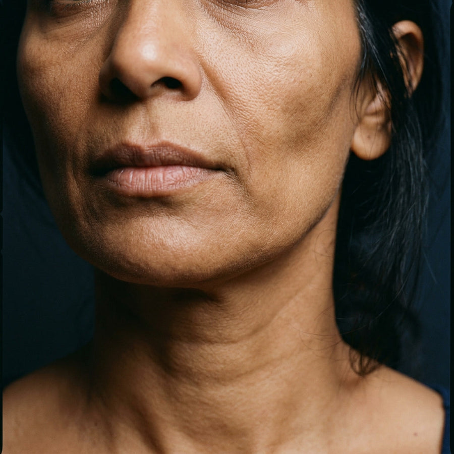 Facial Volume Loss